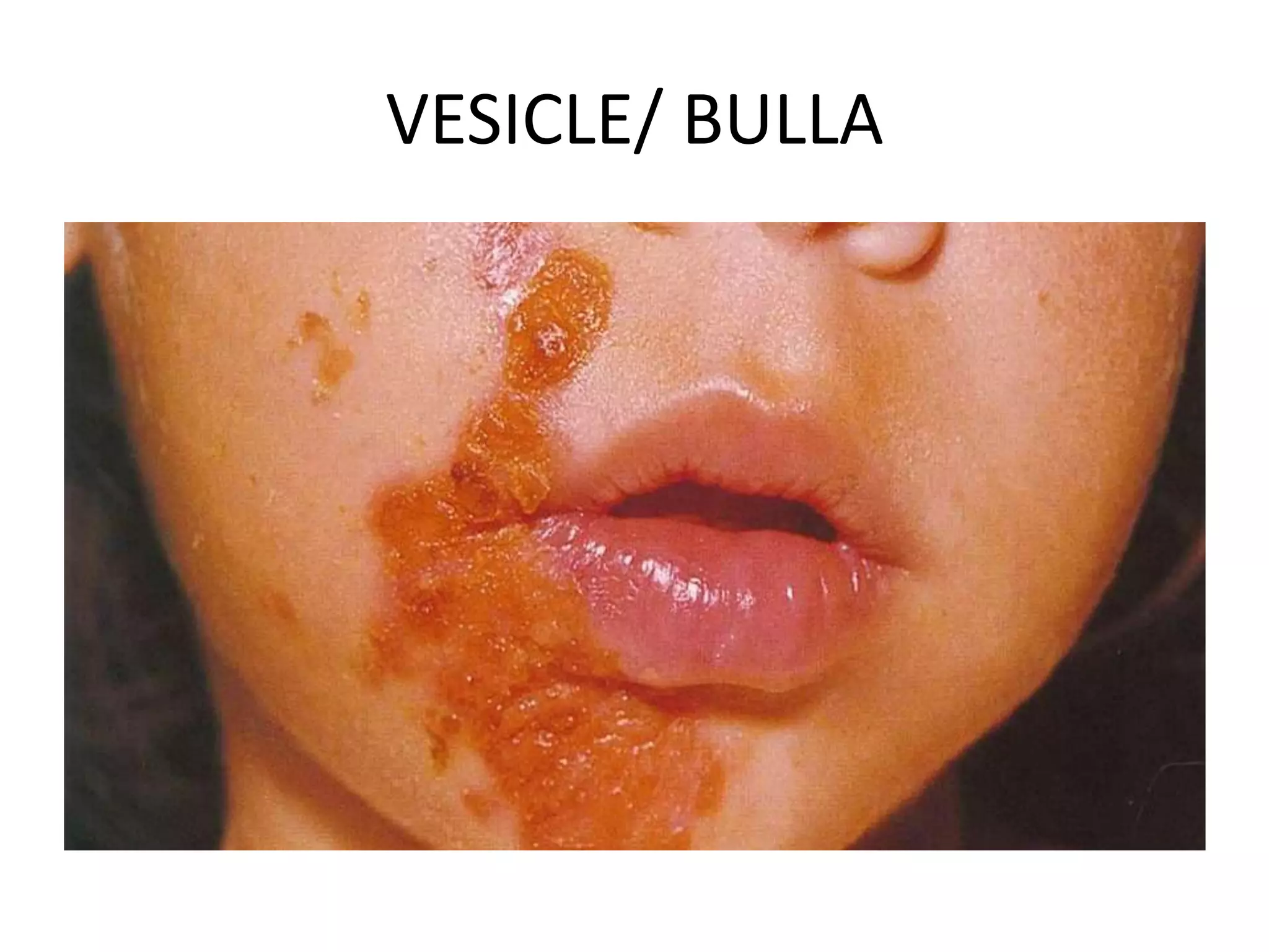 Primary Skin Lesions by Aseem | PPTX