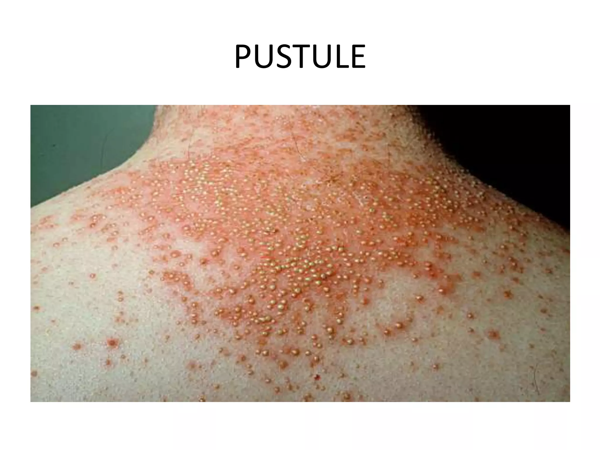Primary Skin Lesions by Aseem | PPTX