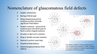 Primary open angle glaucoma | PPTX