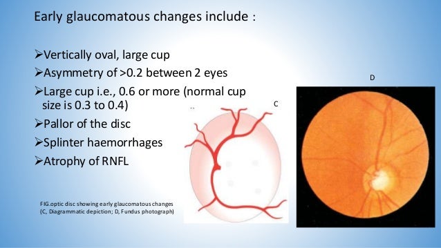 Primary Open Angle Glaucoma