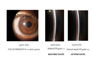 Comprehensive Case Study on Primary Angle Closure Glaucoma Management | PDF