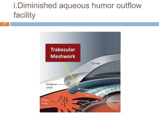 i.Diminished aqueous humor outflow
facility
17
 
