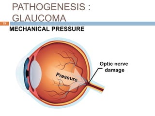 PATHOGENESIS :
GLAUCOMA
MECHANICAL PRESSURE
29
 