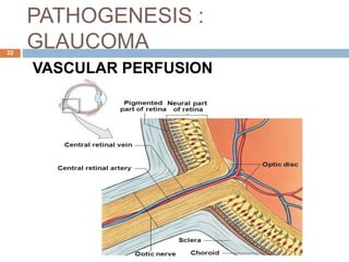 PATHOGENESIS :
GLAUCOMA
VASCULAR PERFUSION
32
 