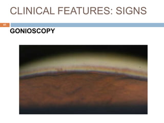 CLINICAL FEATURES: SIGNS
GONIOSCOPY
41
 