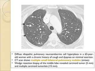 • Diffuse idiopathic pulmonary neuroendocrine cell hyperplasia in a 63-year-
old woman with a chronic history of cough and dyspnea on minimal exertion.
• CT scan shows multiple small bilateral pulmonary nodules (arrows).
• Wedge resection biopsy of the middle lobe revealed carcinoid tumor (5 mm)
and multiple carcinoid tumorlets (<5 mm).
 