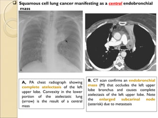 A, PA chest radiograph showing
complete atelectasis of the left
upper lobe. Convexity in the lower
portion of the atelectatic lung
(arrow) is the result of a central
mass
B, CT scan confirms an endobronchial
mass (M) that occludes the left upper
lobe bronchus and causes complete
atelectasis of the left upper lobe. Note
the enlarged subcarinal node
(asterisk) due to metastasis
 Squamous cell lung cancer manifesting as a central endobronchial
mass
 