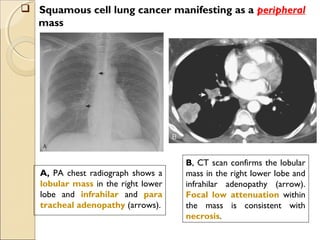 A, PA chest radiograph shows a
lobular mass in the right lower
lobe and infrahilar and para
tracheal adenopathy (arrows).
B, CT scan confirms the lobular
mass in the right lower lobe and
infrahilar adenopathy (arrow).
Focal low attenuation within
the mass is consistent with
necrosis.
 Squamous cell lung cancer manifesting as a peripheral
mass
 