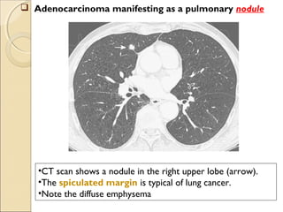 •CT scan shows a nodule in the right upper lobe (arrow).
•The spiculated margin is typical of lung cancer.
•Note the diffuse emphysema
 Adenocarcinoma manifesting as a pulmonary nodule
 