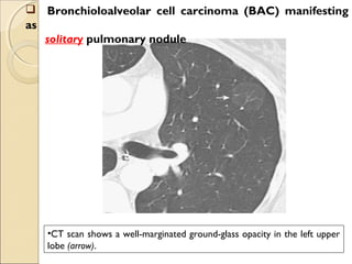 •CT scan shows a well-marginated ground-glass opacity in the left upper
lobe (arrow).
 Bronchioloalveolar cell carcinoma (BAC) manifesting
as
solitary pulmonary nodule
 