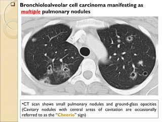 •CT scan shows small pulmonary nodules and ground-glass opacities
(Cavitary nodules with central areas of cavitation are occasionally
referred to as the “Cheerio” sign)
 Bronchioloalveolar cell carcinoma manifesting as
multiple pulmonary nodules
 