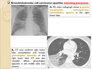  Bronchioloalveolar cell carcinoma opacities mimicking pneumonia
A, PA chest radiograph shows a poorly
marginated, homogeneous,
consolidative opacity in the right
lower lobe.
B, CT scan confirms right lower
lobe consolidation and reveals
ground-glass opacities in the
right lower lobe. CT scan also
revealed diffuse ground-glass
opacities in the middle lobe (not
shown).
 