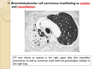 CT scan shows an opacity in the right upper lobe that resembles
pneumonia, as well as numerous small solid and ground-glass nodules in
the right lung
 Bronchioloalveolar cell carcinoma manifesting as nodules
and consolidation.
 