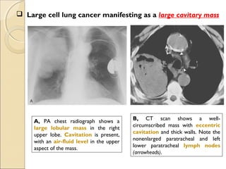 A, PA chest radiograph shows a
large lobular mass in the right
upper lobe. Cavitation is present,
with an air-fluid level in the upper
aspect of the mass.
B, CT scan shows a well-
circumscribed mass with eccentric
cavitation and thick walls. Note the
nonenlarged paratracheal and left
lower paratracheal lymph nodes
(arrowheads).
 Large cell lung cancer manifesting as a large cavitary mass
 