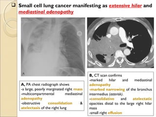 A, PA chest radiograph shows
-a large, poorly marginated right mass
-multicompartmental mediastinal
adenopathy
-obstructive consolidation &
atelectasis of the right lung
B, CT scan confirms
-marked hilar and mediastinal
adenopathy
-marked narrowing of the bronchus
intermedius (asterisk).
-consolidative and atelectatic
opacities distal to the large right hilar
mass
-small right effusion
 Small cell lung cancer manifesting as extensive hilar and
mediastinal adenopathy
 