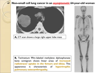  Non–small cell lung cancer in an asymptomatic 64-year-old woman
A, CT scan shows a large right upper lobe mass
B, Technetium 99m–labeled methylene diphosphonate
bone scintigram shows linear areas of increased
radiotracer uptake in the femurs and tibias. This
appearance is characteristic of hypertrophic
pulmonary osteoarthropathy.
 
