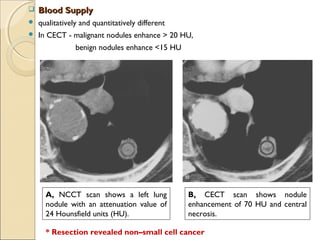  Blood SupplyBlood Supply
 qualitatively and quantitatively different
 In CECT - malignant nodules enhance > 20 HU,
benign nodules enhance <15 HU
A, NCCT scan shows a left lung
nodule with an attenuation value of
24 Hounsfield units (HU).
B, CECT scan shows nodule
enhancement of 70 HU and central
necrosis.
* Resection revealed non–small cell cancer
 