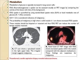  MetabolismMetabolism
 Metabolism of glucose is typically increased in lung cancer cells
 FDG (fluorodeoxyglucose ) uptake can be assessed visually on PET images by comparing the
activity of the lesion with that of the background.
 FDG uptake is quantified by using standardized uptake value (SUV) or local metabolic rate of
glucose (Ki = influx constant).
 SUV > 2.5 is considered indicative of malignancy.
 The probability of malignancy is high when a solid nodule ≥ 1 cm shows increased FDG uptake
 These nodules should be biopsied or resected and thus FDG PET can reduce the number of
benign nodules resected.
A, CT scan shows a spiculated nodule
in the right upper lobe. The irregular
margin suggests malignancy.
B, Axial fused CT PET image with FDG
shows increased uptake within the nodule
compared with the adjacent mediastinum.
These findings are suspicious for
malignancy.
* Transthoracic needle aspiration biopsy revealed adenocarcinoma
 