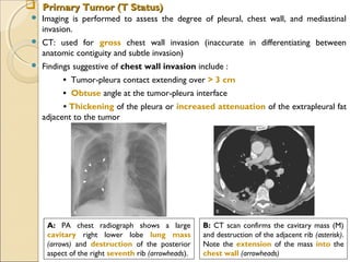  Primary Tumor (T Status)Primary Tumor (T Status)
 Imaging is performed to assess the degree of pleural, chest wall, and mediastinal
invasion.
 CT: used for gross chest wall invasion (inaccurate in differentiating between
anatomic contiguity and subtle invasion)
 Findings suggestive of chest wall invasion include : 
•  Tumor-pleura contact extending over > 3 cm
•  Obtuse angle at the tumor-pleura interface
   • Thickening of the pleura or increased attenuation of the extrapleural fat
adjacent to the tumor
A: PA chest radiograph shows a large
cavitary right lower lobe lung mass
(arrows) and destruction of the posterior
aspect of the right seventh rib (arrowheads).
B: CT scan confirms the cavitary mass (M)
and destruction of the adjacent rib (asterisk).
Note the extension of the mass into the
chest wall (arrowheads)
 