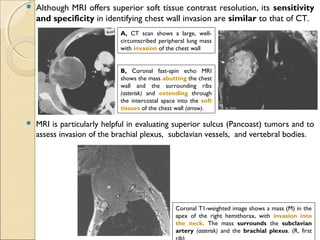 Although MRI offers superior soft tissue contrast resolution, its sensitivity
and specificity in identifying chest wall invasion are similar to that of CT.
 MRI is particularly helpful in evaluating superior sulcus (Pancoast) tumors and to
assess invasion of the brachial plexus, subclavian vessels, and vertebral bodies.
A, CT scan shows a large, well-
circumscribed peripheral lung mass
with invasion of the chest wall
B, Coronal fast-spin echo MRI
shows the mass abutting the chest
wall and the surrounding ribs
(asterisk) and extending through
the intercostal space into the soft
tissues of the chest wall (arrow).
Coronal T1-weighted image shows a mass (M) in the
apex of the right hemithorax, with invasion into
the neck. The mass surrounds the subclavian
artery (asterisk) and the brachial plexus. (R, first
 