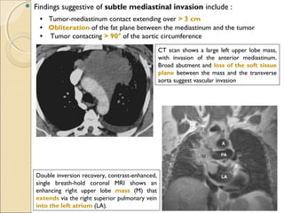  Findings suggestive of subtle mediastinal invasion include :
•   Tumor-mediastinum contact extending over > 3 cm
   •   Obliteration of the fat plane between the mediastinum and the tumor
   •    Tumor contacting > 90° of the aortic circumference
CT scan shows a large left upper lobe mass,
with invasion of the anterior mediastinum.
Broad abutment and loss of the soft tissue
plane between the mass and the transverse
aorta suggest vascular invasion
Double inversion recovery, contrast-enhanced,
single breath-hold coronal MRI shows an
enhancing right upper lobe mass (M) that
extends via the right superior pulmonary vein
into the left atrium (LA).
 