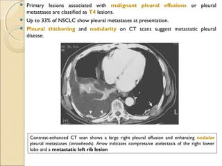  Primary lesions associated with malignant pleural effusions or pleural
metastases are classified as T4 lesions.
 Up to 33% of NSCLC show pleural metastases at presentation.
 Pleural thickening and nodularity on CT scans suggest metastatic pleural
disease.
Contrast-enhanced CT scan shows a large right pleural effusion and enhancing nodular
pleural metastases (arrowheads). Arrow indicates compressive atelectasis of the right lower
lobe and a metastatic left rib lesion
 