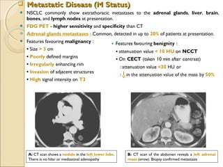  NSCLC commonly show extrathoracic metastases to the adrenal glands, liver, brain,
bones, and lymph nodes at presentation.
 FDG PET - higher sensitivity and specificity than CT
 Adrenal glands metastases : Common, detected in up to 20% of patients at presentation.
 Features favouring malignancy :
   • Size > 3 cm
   • Poorly defined margins
   • Irregularly enhancing rim
   • Invasion of adjacent structures
   • High signal intensity on T2
 Metastatic Disease (M Status)Metastatic Disease (M Status)
A: CT scan shows a nodule in the left lower lobe.
There is no hilar or mediastinal adenopathy
B: CT scan of the abdomen reveals a left adrenal
mass (arrow). Biopsy confirmed metastasis
 