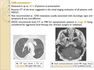  CNS metastases –
 Detected in up to 18 % of patients at presentation.
 Routine CT of the brain suggested in the initial staging evaluation of all patients with
NSCLC
 Not recommended as : CNS metastases usually associated with neurologic signs and
symptoms & not cost-effective.
 ASCO recommends brain CT or MRI for asymptomatic patients in stage III being
considered for aggressive local therapy (viz. thoracic surgery or radiation).
A: CT scan shows a 3.5 cm
spiculated left upper lobe mass.
B: Axial contrast-enhanced cranial MR image shows
an enhancing metastasis in the cerebellum (arrow).
 