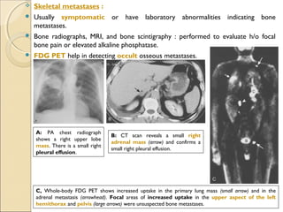  Skeletal metastases :
 Usually symptomatic or have laboratory abnormalities indicating bone
metastases.
 Bone radiographs, MRI, and bone scintigraphy : performed to evaluate h/o focal
bone pain or elevated alkaline phosphatase.
 FDG PET help in detecting occult osseous metastases.
A: PA chest radiograph
shows a right upper lobe
mass. There is a small right
pleural effusion.
B: CT scan reveals a small right
adrenal mass (arrow) and confirms a
small right pleural effusion.
C, Whole-body FDG PET shows increased uptake in the primary lung mass (small arrow) and in the
adrenal metastasis (arrowhead). Focal areas of increased uptake in the upper aspect of the left
hemithorax and pelvis (large arrows) were unsuspected bone metastases.
 