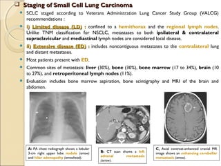  Staging of Small Cell Lung CarcinomaStaging of Small Cell Lung Carcinoma
 SCLC staged according to Veterans Administration Lung Cancer Study Group (VALCG)
recommendations :
 i)i) Limited disease (LD)Limited disease (LD) :: confined to a hemithorax and the regional lymph nodes.
Unlike TNM classification for NSCLC, metastases to both ipsilateral & contralateral
supraclavicular and mediastinal lymph nodes are considered local disease.
 ii)ii) Extensive disease (ED)Extensive disease (ED) :: includes noncontiguous metastases to the contralateral lung
and distant metastases.
 Most patients present with ED.
 Common sites of metastasis: liver (30%), bone (30%), bone marrow (17 to 34%), brain (10
to 27%), and retroperitoneal lymph nodes (11%).
 Evaluation includes bone marrow aspiration, bone scintigraphy and MRI of the brain and
abdomen.
A: PA chest radiograph shows a lobular
3-cm right upper lobe nodule (arrow)
and hilar adenopathy (arrowhead).
B: CT scan shows a left
adrenal metastasis
(arrow).
C, Axial contrast-enhanced cranial MR
image shows an enhancing cerebellar
metastasis (arrow).
 