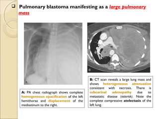  Pulmonary blastoma manifesting as a large pulmonary
mass
A: PA chest radiograph shows complete
homogeneous opacification of the left
hemithorax and displacement of the
mediastinum to the right.
B: CT scan reveals a large lung mass and
shows heterogeneous attenuation
consistent with necrosis. There is
subcarinal adenopathy due to
metastatic disease (asterisk). Note the
complete compressive atelectasis of the
left lung.
 