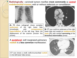  Radiologically : carcinoid tumors manifest most commonly as central
endobronchial masses, with or without atelectasis or consolidation.
A peripheral, well marginated pulmonary
nodule is a less common manifestation.
A: PA chest radiograph shows complete
atelectasis of the right lower lobe
(arrowheads), with compensatory
hyperinflation of the left lung. Note the
displacement of the anterior junction line
(arrows).
B: CT scan confirms atelectasis of the right
lower lobe and reveals an endobronchial
mass (M), with marked narrowing of the
bronchus intermedius (arrow)
CT scan shows a small, well-circumscribed nodule
in the left lower lobe (arrow).
 