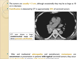  The tumors are usually < 3 cm, although occasionally they may be as large as 10
cm in diameter.
 Calcification is detected by CT in approximately 25% of carcinoid tumors
 Hilar and mediastinal adenopathy and extrathoracic metastases are
uncommon at presentation in patients with typical carcinoid tumors; they occur
CT scan shows a large
endobronchial mass with
dense punctate calcification
 
