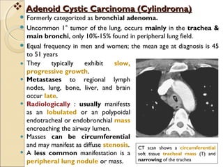  Formerly categorized as bronchial adenoma.
 Uncommon 1° tumor of the lung, occurs mainly in the trachea &
main bronchi, only 10%-15% found in peripheral lung field.
 Equal frequency in men and women; the mean age at diagnosis is 45
to 51 years
 Adenoid Cystic Carcinoma (Cylindroma)Adenoid Cystic Carcinoma (Cylindroma)
They typically exhibit slow,
progressive growth.
Metastases to regional lymph
nodes, lung, bone, liver, and brain
occur late.
Radiologically : usually manifests
as an lobulated or an polypoidal
endotracheal or endobronchial mass
encroaching the airway lumen.
Masses can be circumferential
and may manifest as diffuse stenosis.
A less common manifestation is a
peripheral lung nodule or mass.
CT scan shows a circumferential
soft tissue tracheal mass (T) and
narrowing of the trachea
 