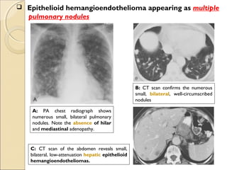  Epithelioid hemangioendothelioma appearing as multiple
pulmonary nodules
A: PA chest radiograph shows
numerous small, bilateral pulmonary
nodules. Note the absence of hilar
and mediastinal adenopathy.
B: CT scan confirms the numerous
small, bilateral, well-circumscribed
nodules
C: CT scan of the abdomen reveals small,
bilateral, low-attenuation hepatic epithelioid
hemangioendotheliomas.
 