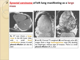  Synovial carcinoma of left lung manifesting as a large
mass
A, CT scan shows a large
mass in the left lower lobe,
with a small focal
calcification (arrow). A small
pleural effusion can also be
seen
B and C, Coronal T1-weighted (B) and fast-spin echo (C)
images show a large heterogeneous mass (M) abutting
the diaphragm, without signs of invasion. There is a small
pleural effusion (P). L, liver
 