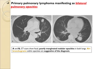  Primary pulmonary lymphoma manifesting as bilateral
pulmonary opacities
A and B, CT scans show focal, poorly marginated nodular opacities in both lungs. Air-
bronchograms within opacities are suggestive of the diagnosis.
 
