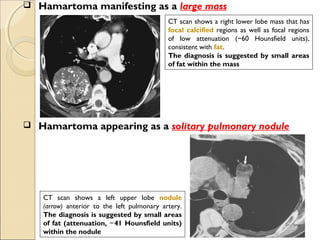  Hamartoma manifesting as a large mass
 Hamartoma appearing as a solitary pulmonary nodule
CT scan shows a left upper lobe nodule
(arrow) anterior to the left pulmonary artery.
The diagnosis is suggested by small areas
of fat (attenuation, 41 Hounsfield units)−
within the nodule
CT scan shows a right lower lobe mass that has
focal calcified regions as well as focal regions
of low attenuation ( 60 Hounsfield units),−
consistent with fat.
The diagnosis is suggested by small areas
of fat within the mass
 