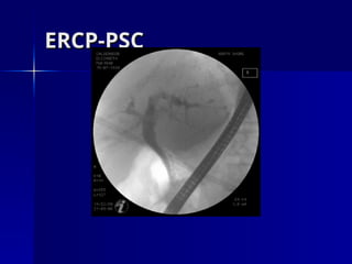 ERCP-PSC
ERCP-PSC
 