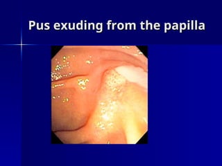 Pus exuding from the papilla
Pus exuding from the papilla
 
