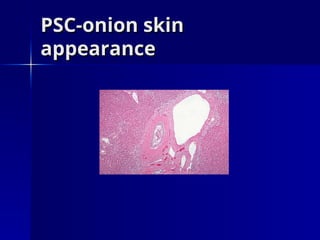 PSC-onion skin
PSC-onion skin
appearance
appearance
 