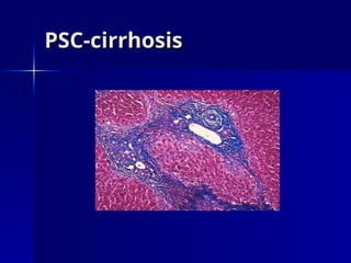 PSC-cirrhosis
PSC-cirrhosis
 