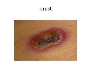 Diffuse Rash Crust Comprehensive Overview of Primary, Secondary, and Special Skin Lesions ...