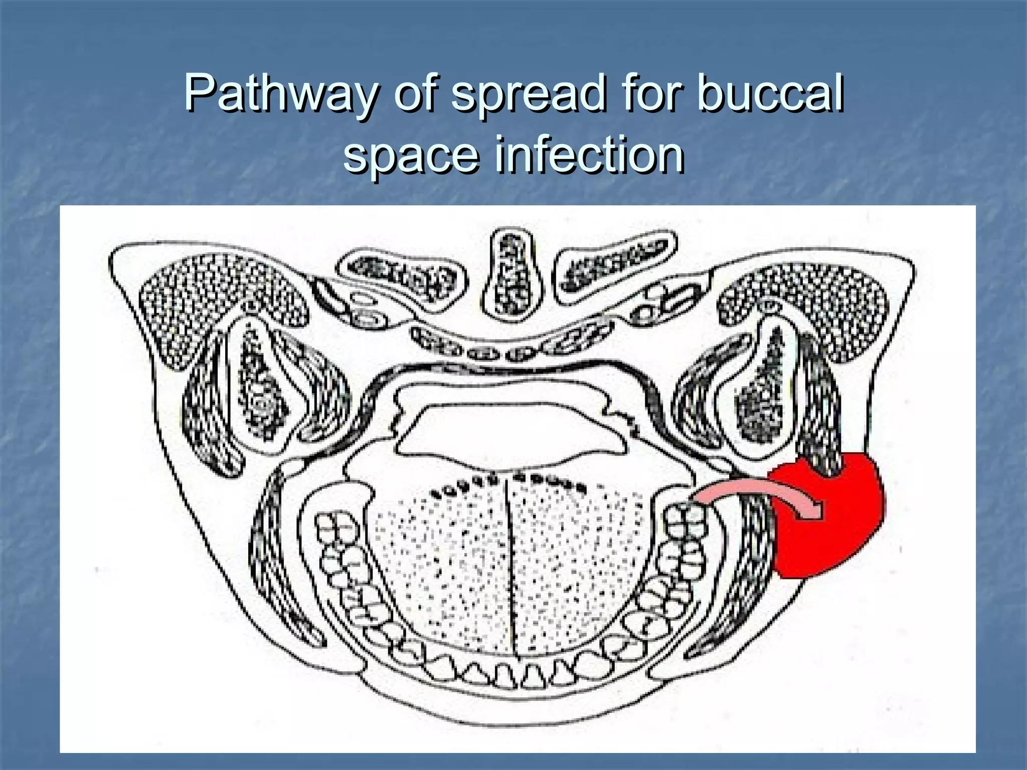 Primary spaces infection | PPT