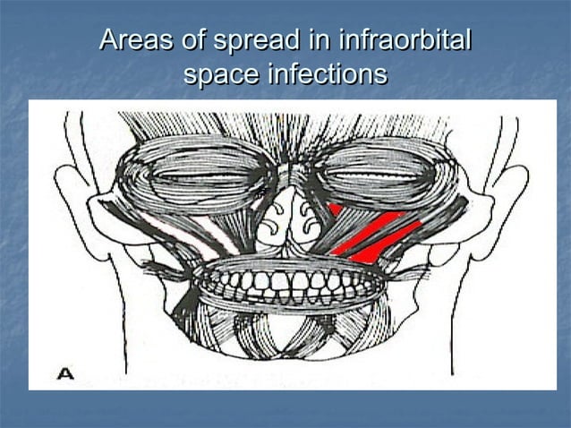 Primary spaces infection | PPT