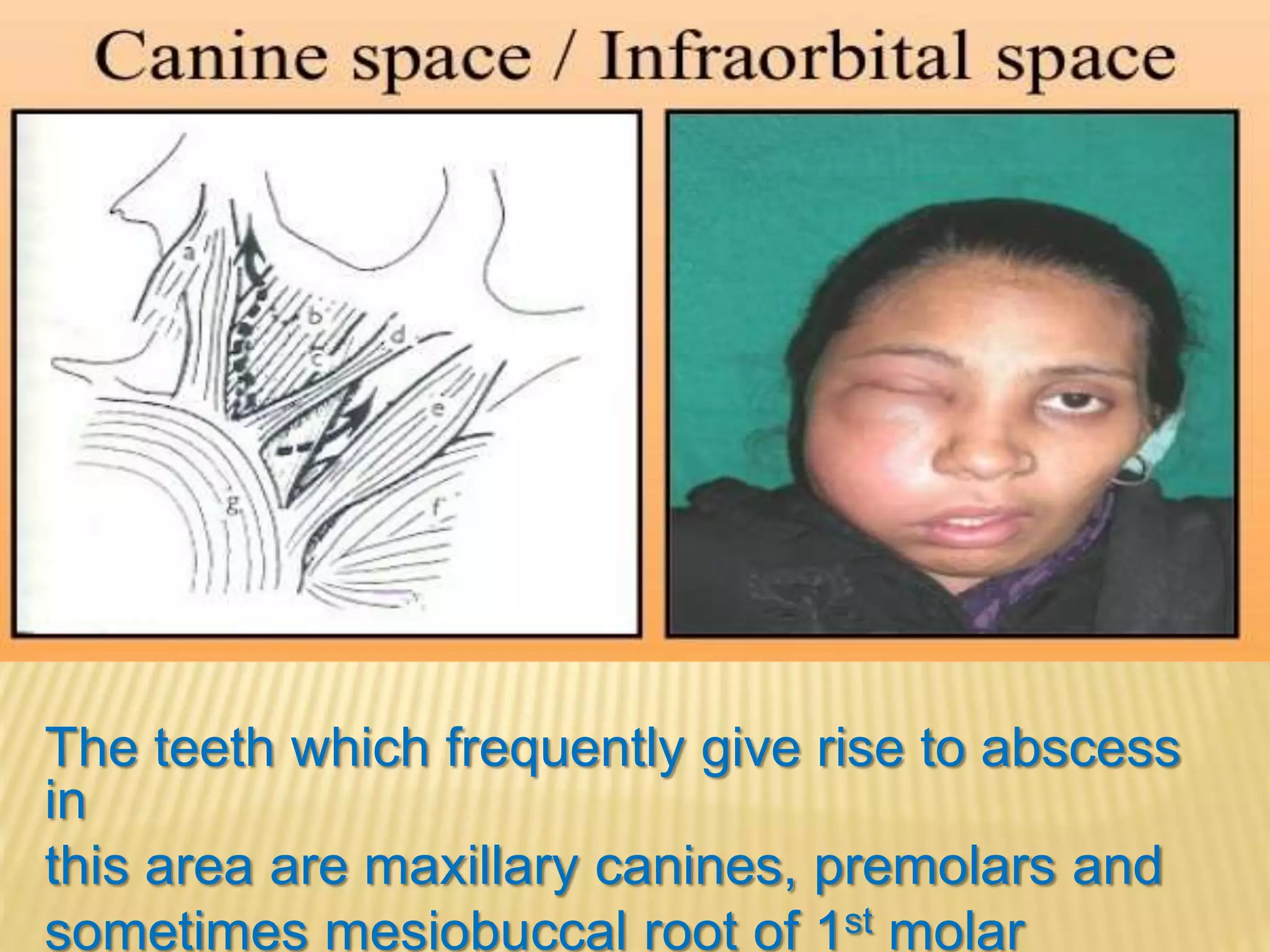 Primary spaces of space infection | PPTX