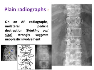 Primary spine tumors | PPT