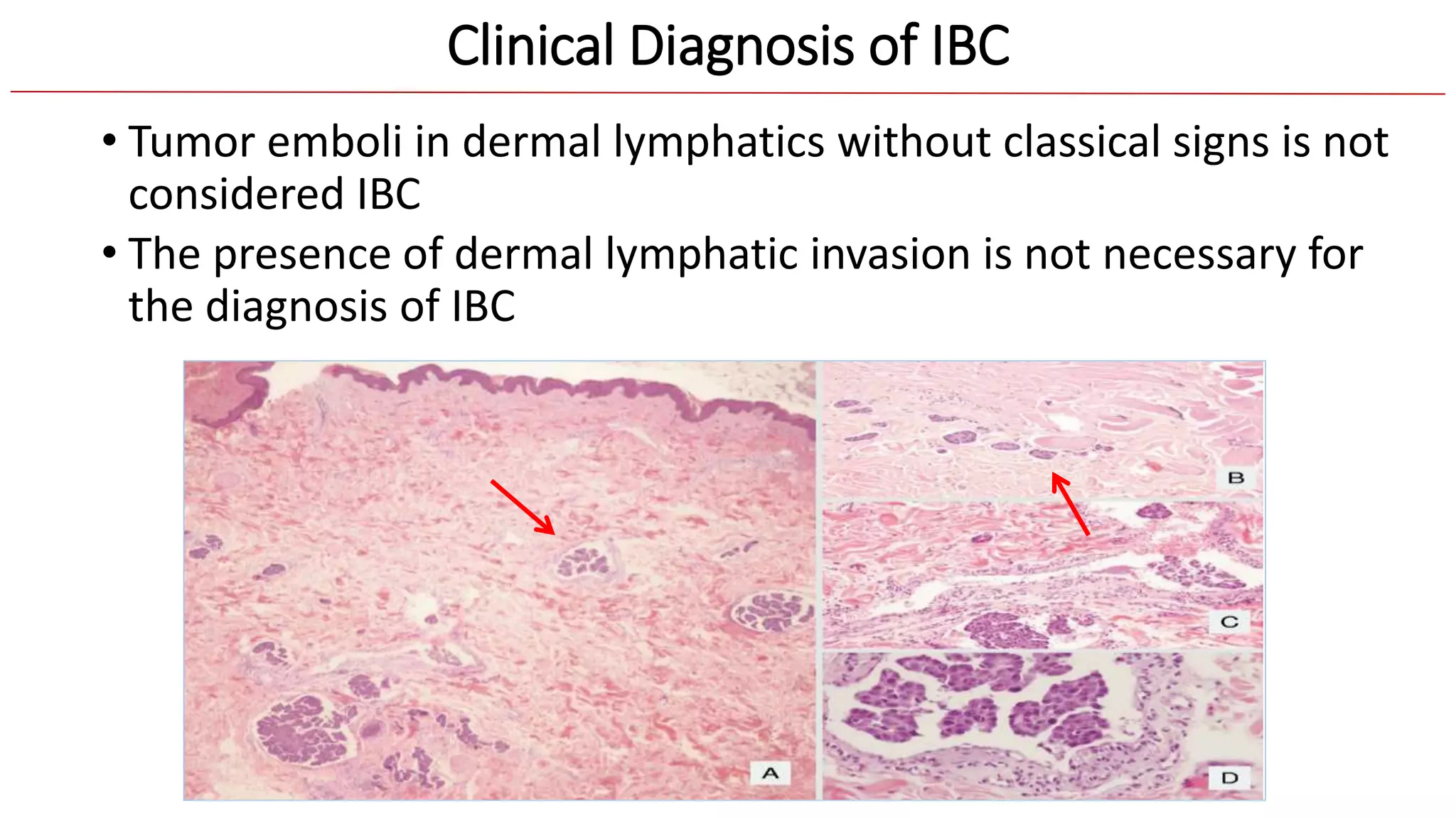 Primary Systemic Therapy for Inflammatory Breast Cancer | PPTX