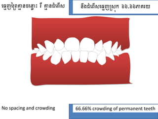 ធ្មេញព្រៃគ្មេ នចធ្្ល ោះ រឺ គ្មេ នំពធ្ៃ នឹងំពធ្ៃ ធ្មេញរ ុក ៦៦.៦៦ភាគរយ
No spacing and crowding 66.66% crowding of permanent teeth
 