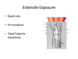 Extensile Exposure
• Quad snip
• VY turndown
• Tibial Tubercle
osteotomy
 